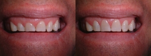 gummy-smile---before-and-after